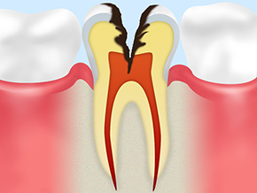C4歯根まで達した虫歯