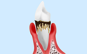 重度歯周病（歯周炎）：歯周外科治療など
