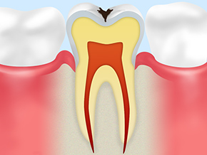 C2：象牙質の虫歯