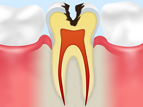 C3：神経に達した虫歯