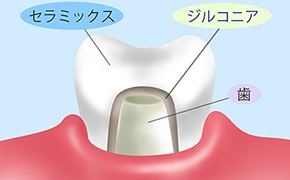 ジルコニア