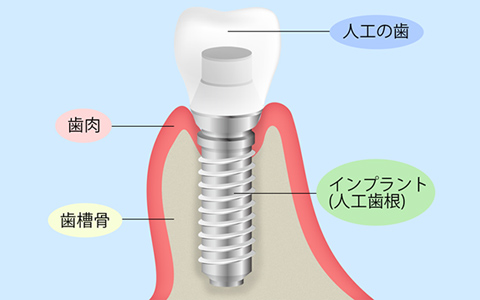 当院のインプラント治療について