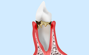 軽度歯周炎（歯肉炎・歯周炎）：スケーリング