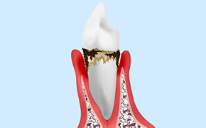 中度歯周病（歯周炎）：ルートプレーニング